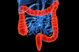 Colorectal cancer